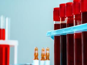 Image from 1977 of blood in vials