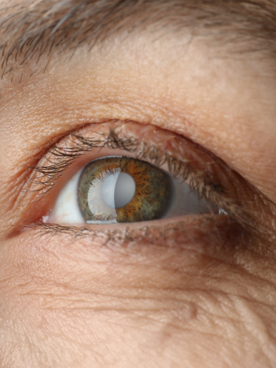 A close up of an eye with cataracts